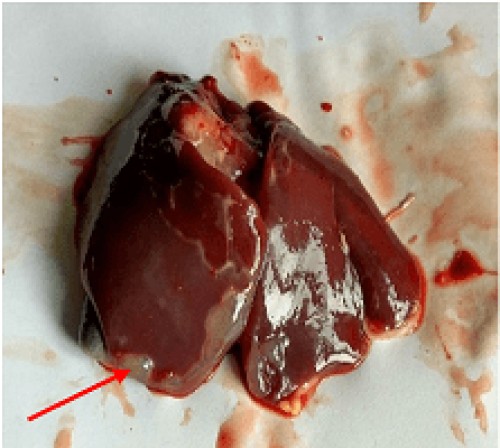 Enlaged liver with blebs of fluid