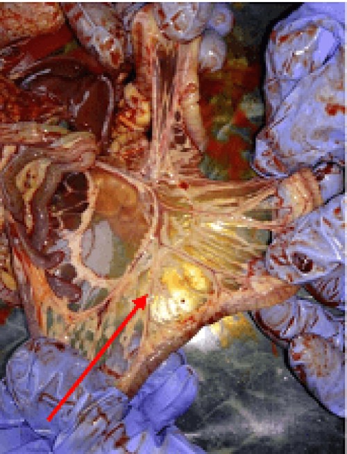 Congested mesentery with fibrin deposit